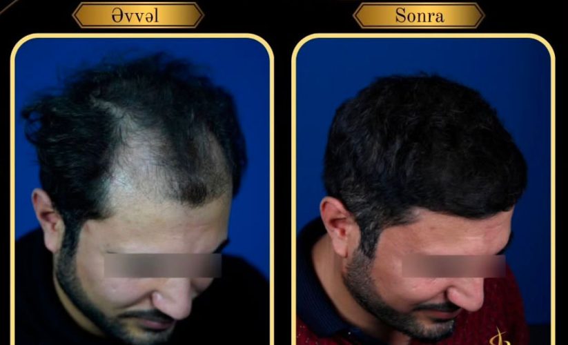 Estetik Görünüşü Pozmadan Saç Əkmə Metodu: Dr. Vaqif Abdullayev İzah Edir