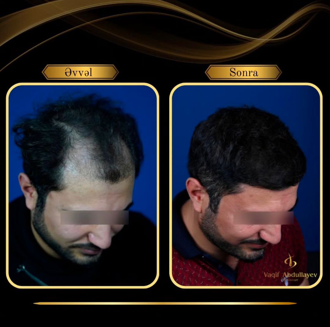 Estetik Görünüşü Pozmadan Saç Əkmə Metodu: Dr. Vaqif Abdullayev İzah Edir