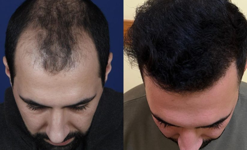 Niyə saç tökülür? Ən çox rast gəlinən 5 səbəb və həlli yolları